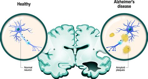 beta-amyloid plaques|Alzheimer's Disease Fact Sheet .